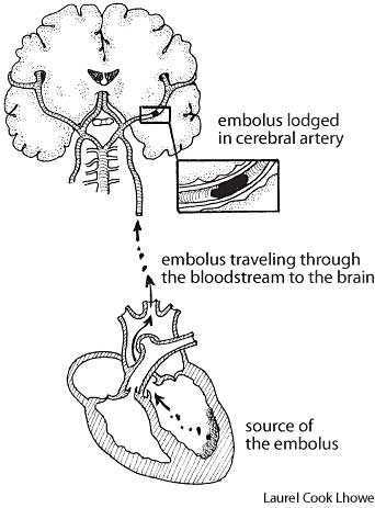 Embolism+vs+thrombosis